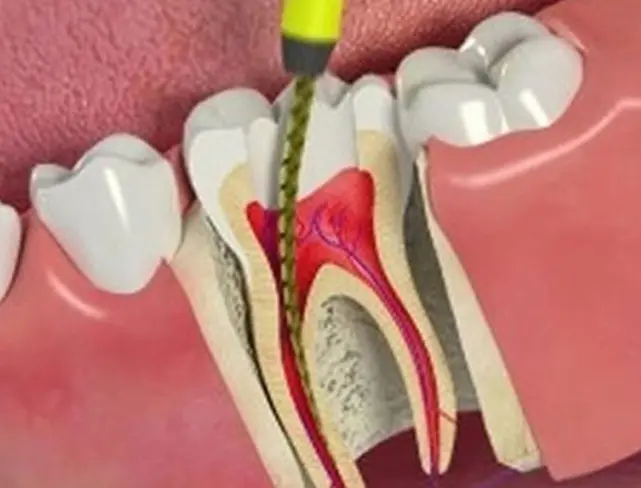 Root-Canal-therapy-thumbnail-641x488