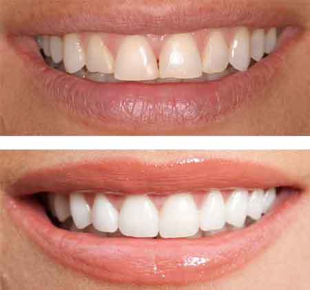 Cosmetic Dentistry | Havelock | Dr. Vipin Grover