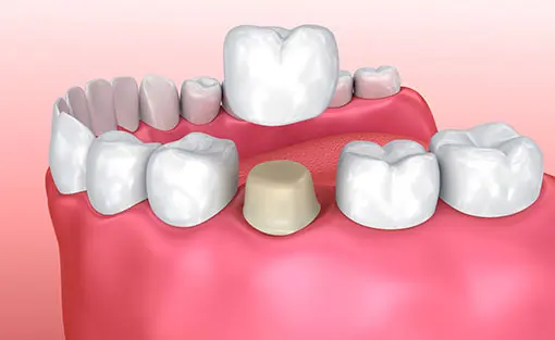 Cosmetic Dentistry | Havelock | Dr. Vipin Grover