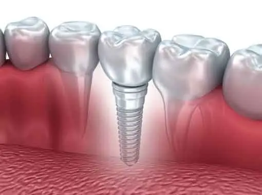 Dental Implants | Havelock | Dr. Vipin Grover