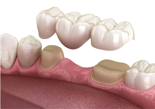 Dental Implants | Havelock | Dr. Vipin Grover