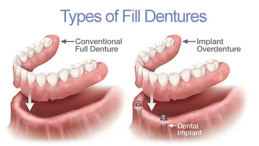 Dental Implants | Havelock | Dr. Vipin Grover